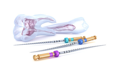Endodoncija – Vađenje živca